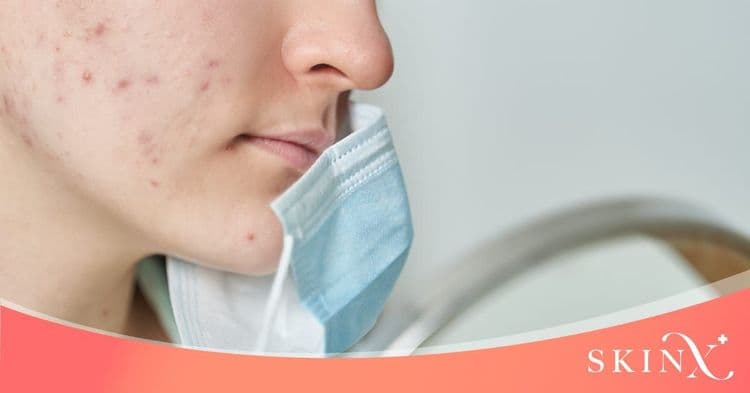 สิวแพ้มาสก์ (Maskne) ปัญหาสิวๆ ที่เกิดจากการใส่หน้ากากอนามัย มีวิธีรักษาอย่างไร