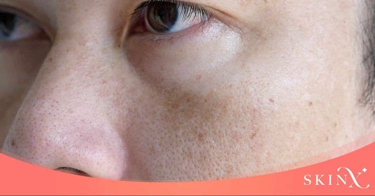 จบปัญหาหน้าพังเป็นหน้าใสด้วยการใช้เลเซอร์ฝ้า