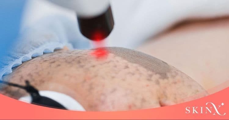 เลเซอร์ แผลเป็น กู้คืนผิวเรียบเนียน ดึงความมั่นใจกลับมาอีกครั้ง