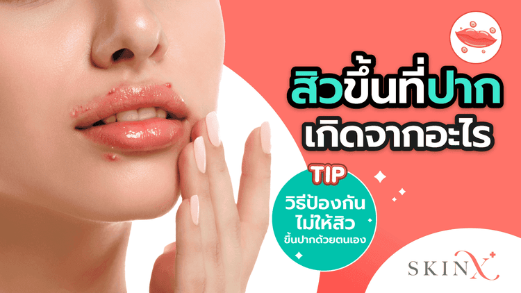 สิวขึ้นรอบปาก มุมปาก ใต้ปาก เกิดจากความสกปรกเพียงอย่างเดียวจริงหรือ?