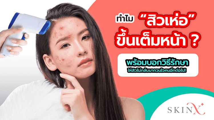 สาเหตุของ สิวเห่อ คืออะไร