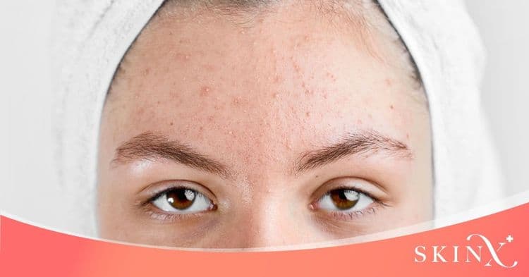 แนะนำการรักษาสิวดูแลผิวหน้าอย่างถูกวิธี ให้ผิวกลับมาเนียนใส