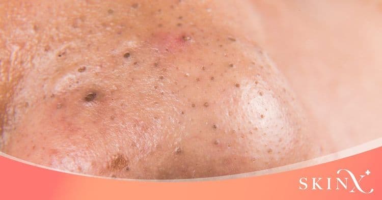 มีสิวตรงจมูก อยากให้ผิวเรียนเนียนควรทำอย่างไร?