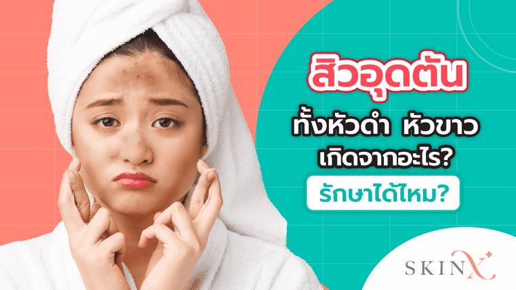 สิวอุดตัน (Comedones) สิวหัวขาว ต้นเหตุของสิวอักเสบ รอยแดง และรอยหลุมสิว!