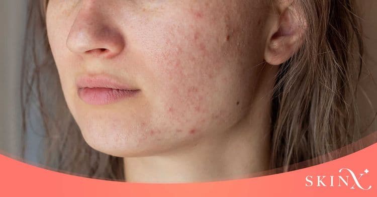 “Dual yellow laser” เทคโนโลยีแก้ปัญหากระ ฝ้า บอกลาหน้าหมองคล้ำและจุดด่างดำ