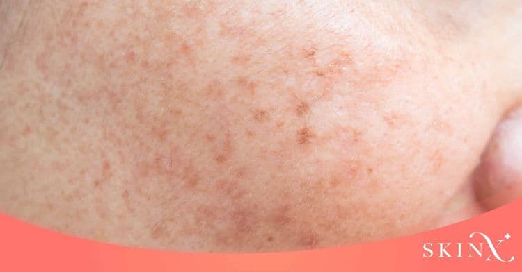 เลเซอร์กระ รักษาปัญหากระแดด กระตื้น กระลึก