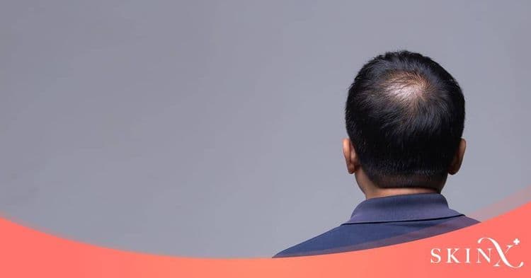 มัดรวมวิธีแก้ผมร่วง ผมบาง แบบปลอดภัย บอกลาปัญหาผมขาดร่วง