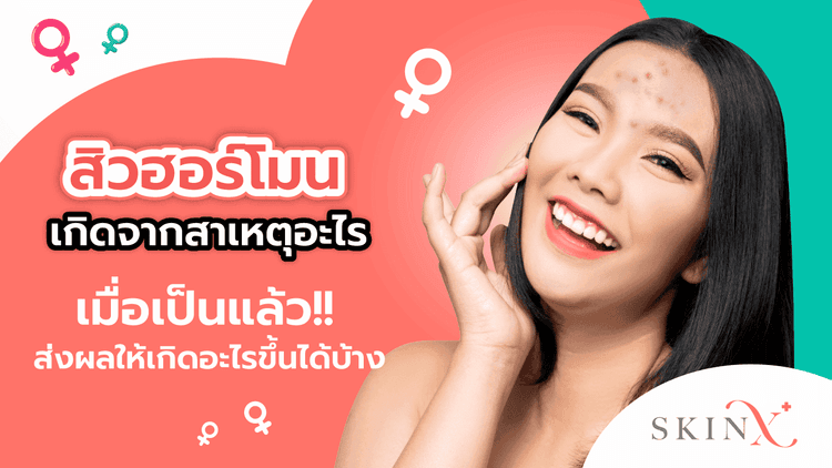 สิวฮอร์โมนในผู้ชายและผู้หญิง สิวประจำเดือน สัญญาณเตือนโรคระบบฮอร์โมน!