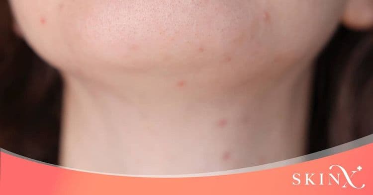 สิวที่คอ เกิดจากอะไร สาเหตุ พร้อมวิธีการดูแลรักษาให้ผิวที่คอกลับมาเรียบเนียน