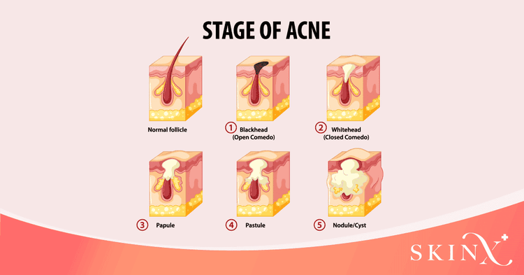 สิวที่หน้าผาก กำลังบอกอะไรกับคุณ - SkinX