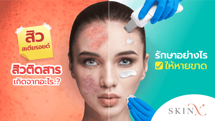หน้าติดสารจนแดงทั้งหน้า สิวขึ้นที่อก อาจเกิดจาก “สิวสเตียรอยด์”