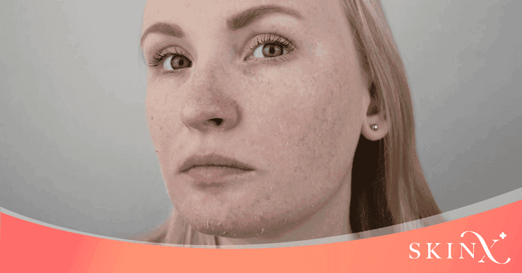 ผิวแห้งเกิดจากอะไร? เรียนรู้สาเหตุและวิธีดูแลผิวให้ชุ่มชื้น